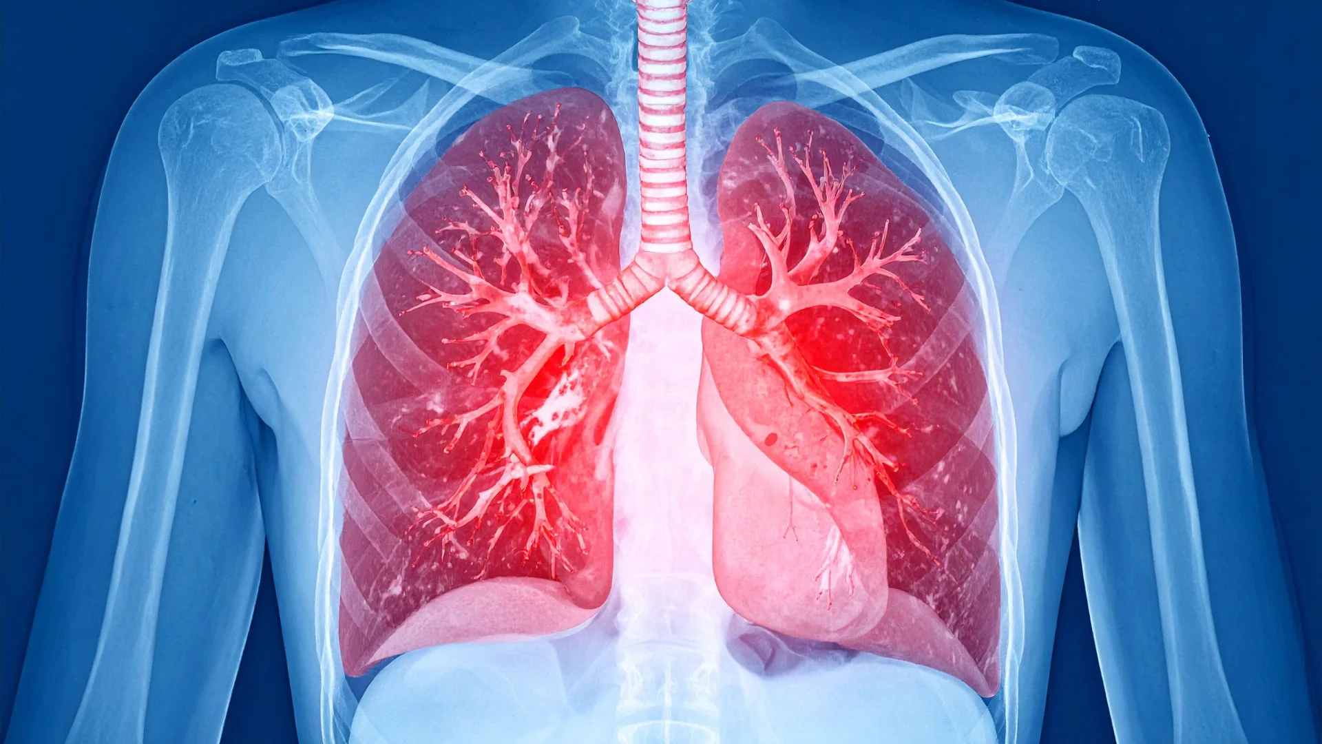 COPD Disease