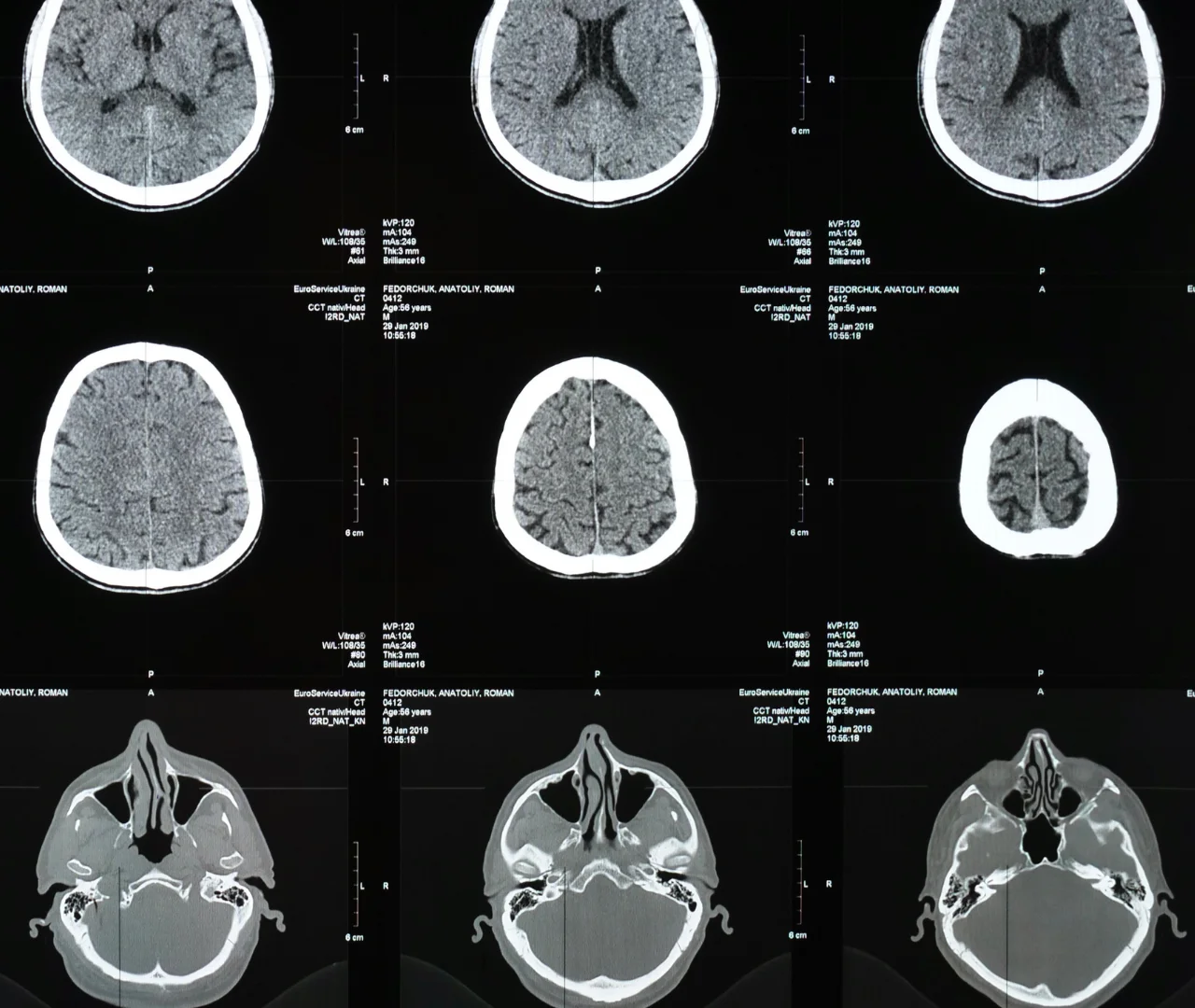 ALS Follow-Up Care