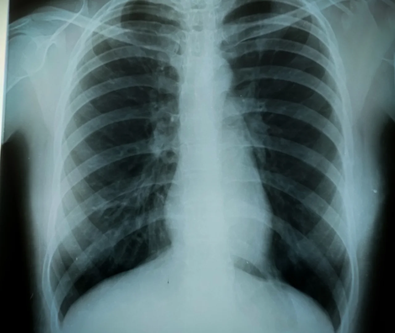COPD Follow-Up Care