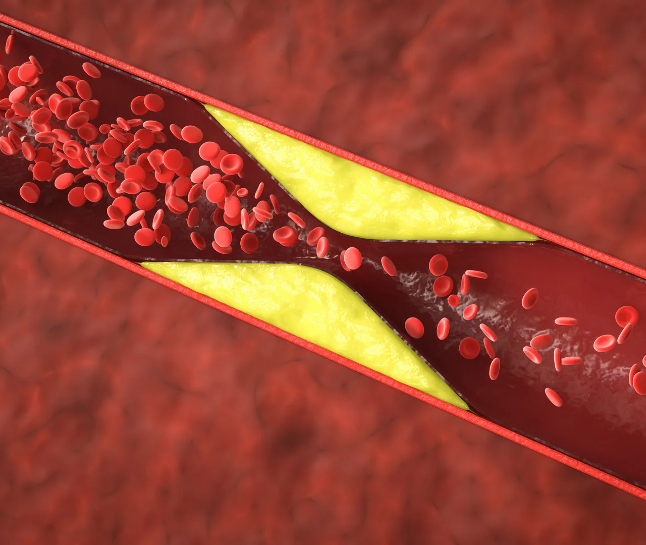 Post Myocardial Infarction Care Journey